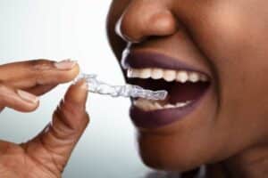 invisalign