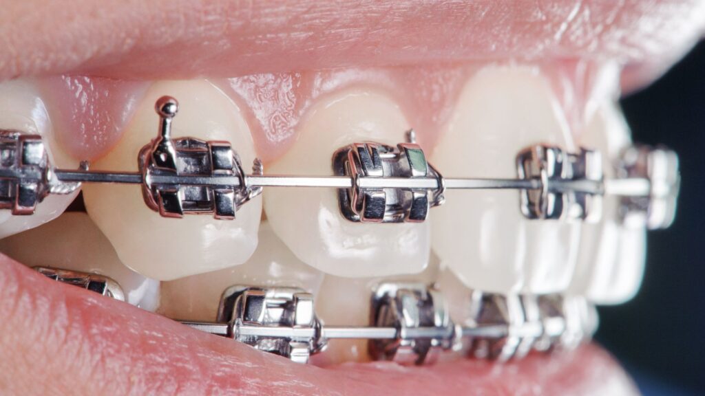 Metal Braces - Are They Still a Good Option