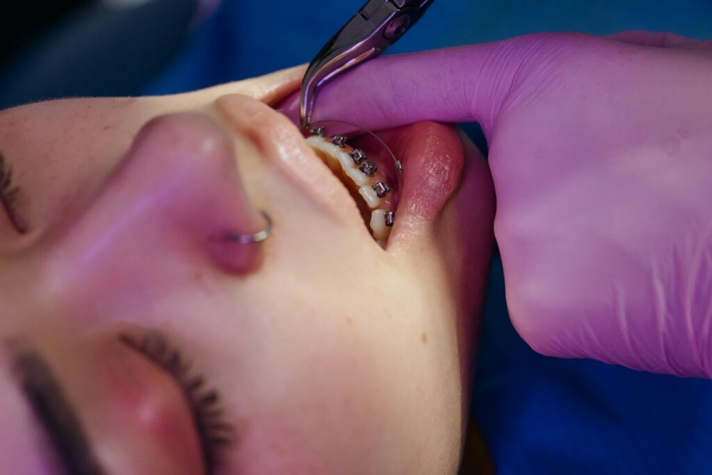 Metal Braces for Teens